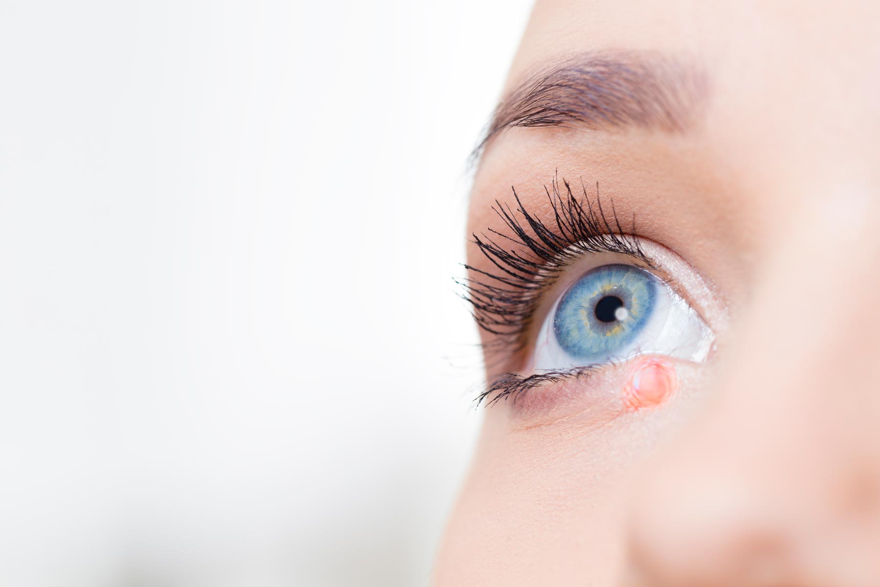 Hordéolo: causas, sintomas e tratamentos - Clínica de Olhos
