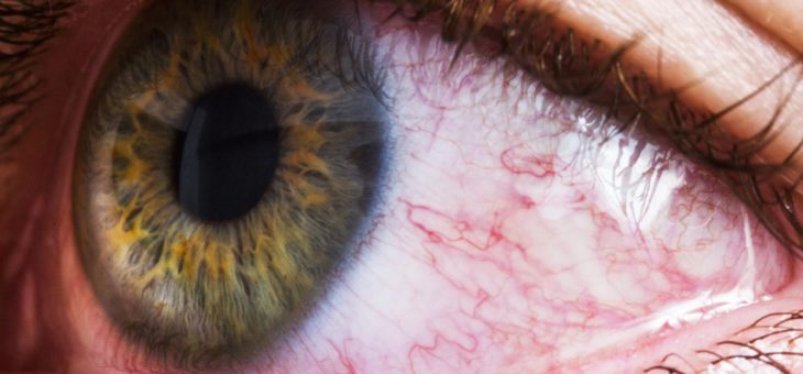 8 causas da vermelhidão ocular: O que fazer? Pode ser grave?