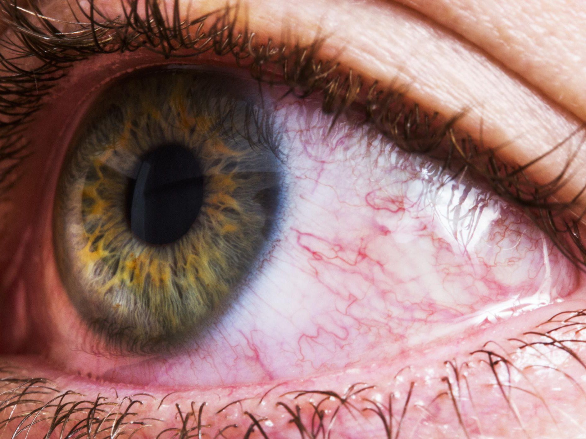 8 causas da vermelhidão ocular: O que fazer? Pode ser grave?