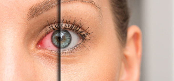 Mitos e Verdades Sobre o Olho Seco