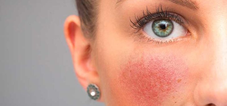 Rosácea aumenta risco de inflamação crônica nas pálpebras e olho seco