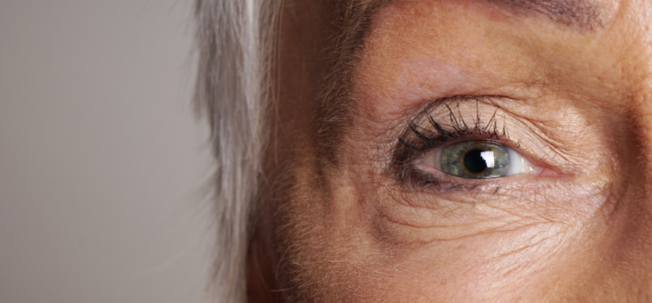 Sinais de envelhecimento ao redor dos olhos