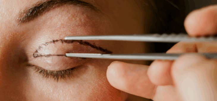 Cicatrização da blefaroplastia – Quanto tempo dura?
