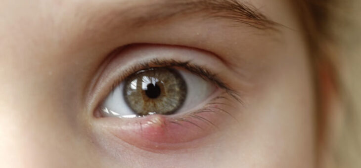 O que é terçol? Sinais Sintomas Tratamento