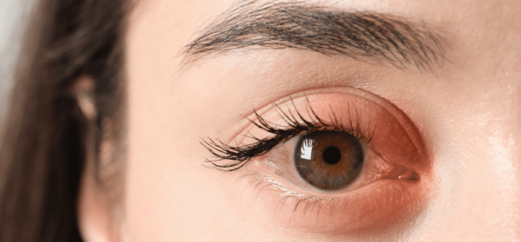 Blefarite e olho seco: o que vem primeiro?