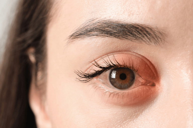 blefarite e olho seco