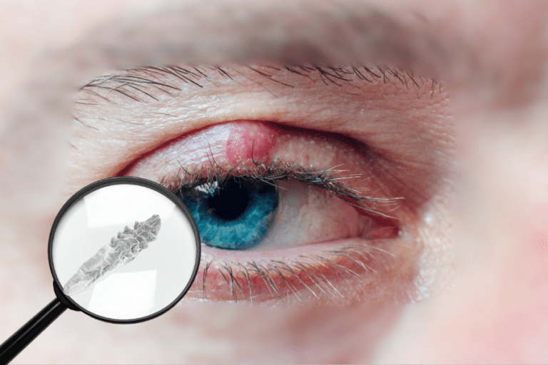 calázio persistente