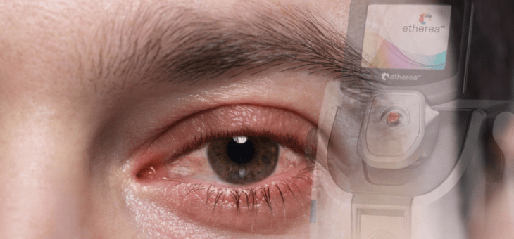 Por que a luz pulsada é considerada um tratamento avançado para blefarite?