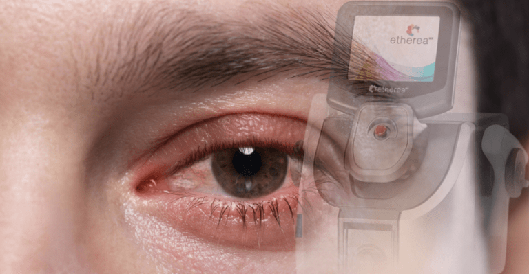 luz intensa pulsada para os olhos