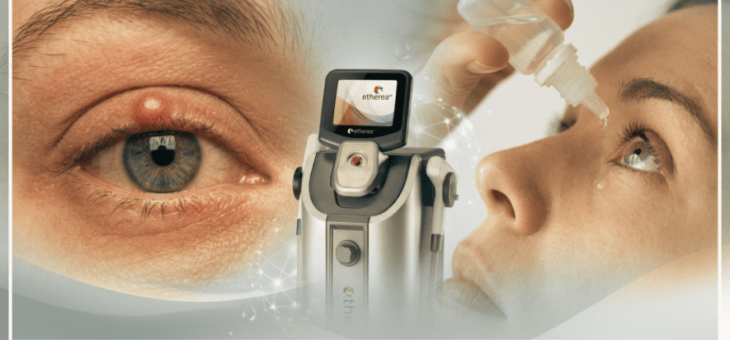 Luz Intensa Pulsada para os olhos: O que você precisa saber