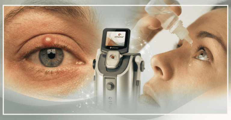 luz intensa pulsada para os olhos